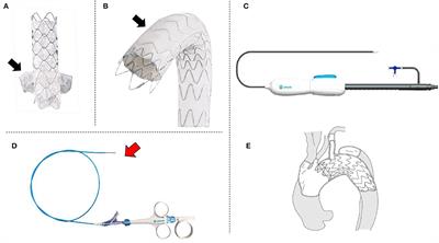 First-in-Human Implantation of Gutter-Free Design Stent-Graft in in situ Fenestration TEVAR for Aortic Arch Pathology